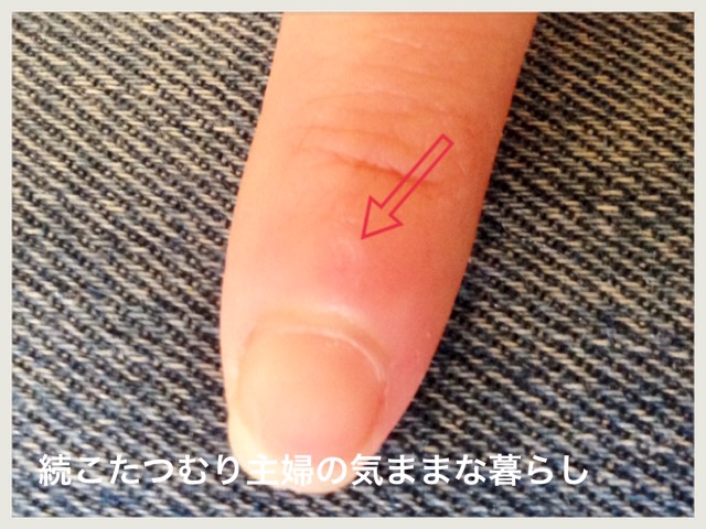 ウイルス性イボ(尋常性疣贅)が子供に感染!思い当たる原因と感染経路と